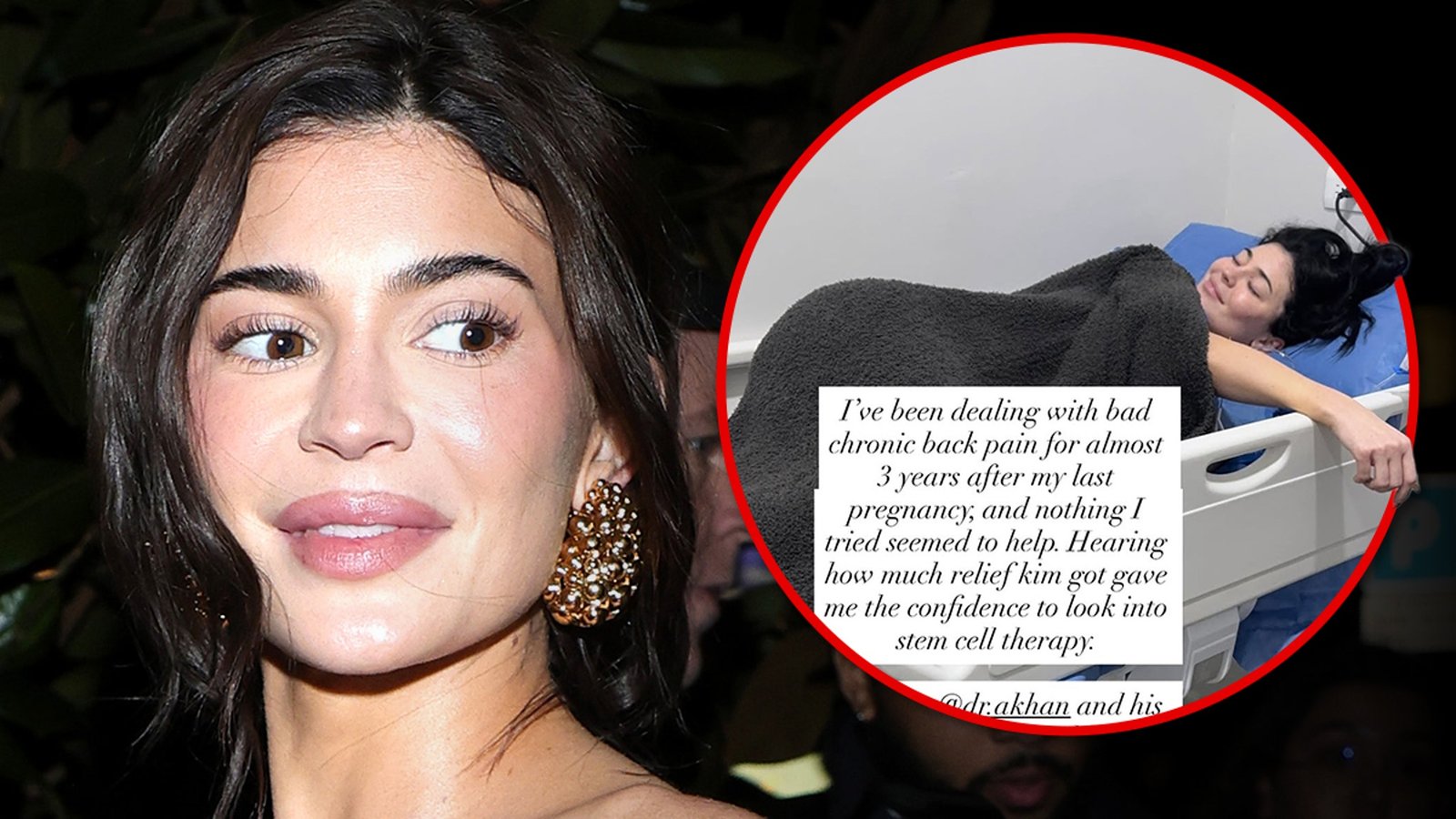 काइली जेनर म्हणते की तिने तीव्र पाठदुखीसाठी स्टेम सेल थेरपी घेतली