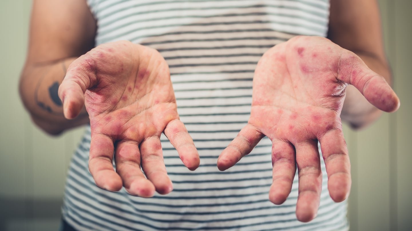 आरोग्य मंत्रालयाने कोस्टा रिका, रुग्ण आणि स्थानांमध्ये गोवरच्या प्रकरणांची पुष्टी केली आहे