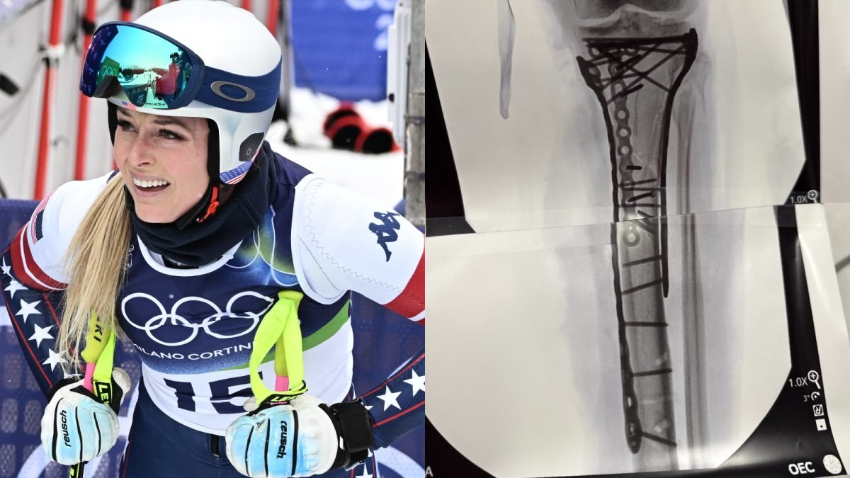 अंगविच्छेदन टाळले होते का? यूएस ऑलिम्पिक स्केटर लिंडसे वॉनने शस्त्रक्रियेबद्दल भयानक तपशील उघड केले | इतर क्रीडा बातम्या